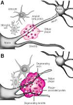 Alzheimer alzheimer placche amiloidi