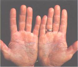 Il re di pelle per accaparrare la psoriasi