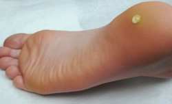 papilloma virus verruche piedi