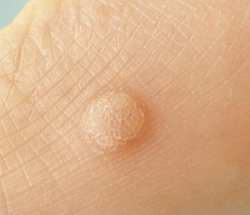 papilloma virus senza verruche)