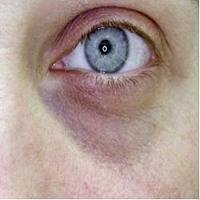 papilloma virus negli uomini come si manifesta otet de mere pentru slabit pareri