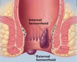 Rimedi per le Emorroidi