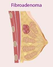 Papilloma benigno seno