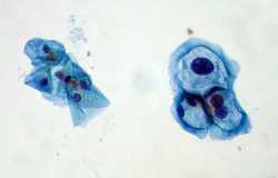 Test herpes genitale